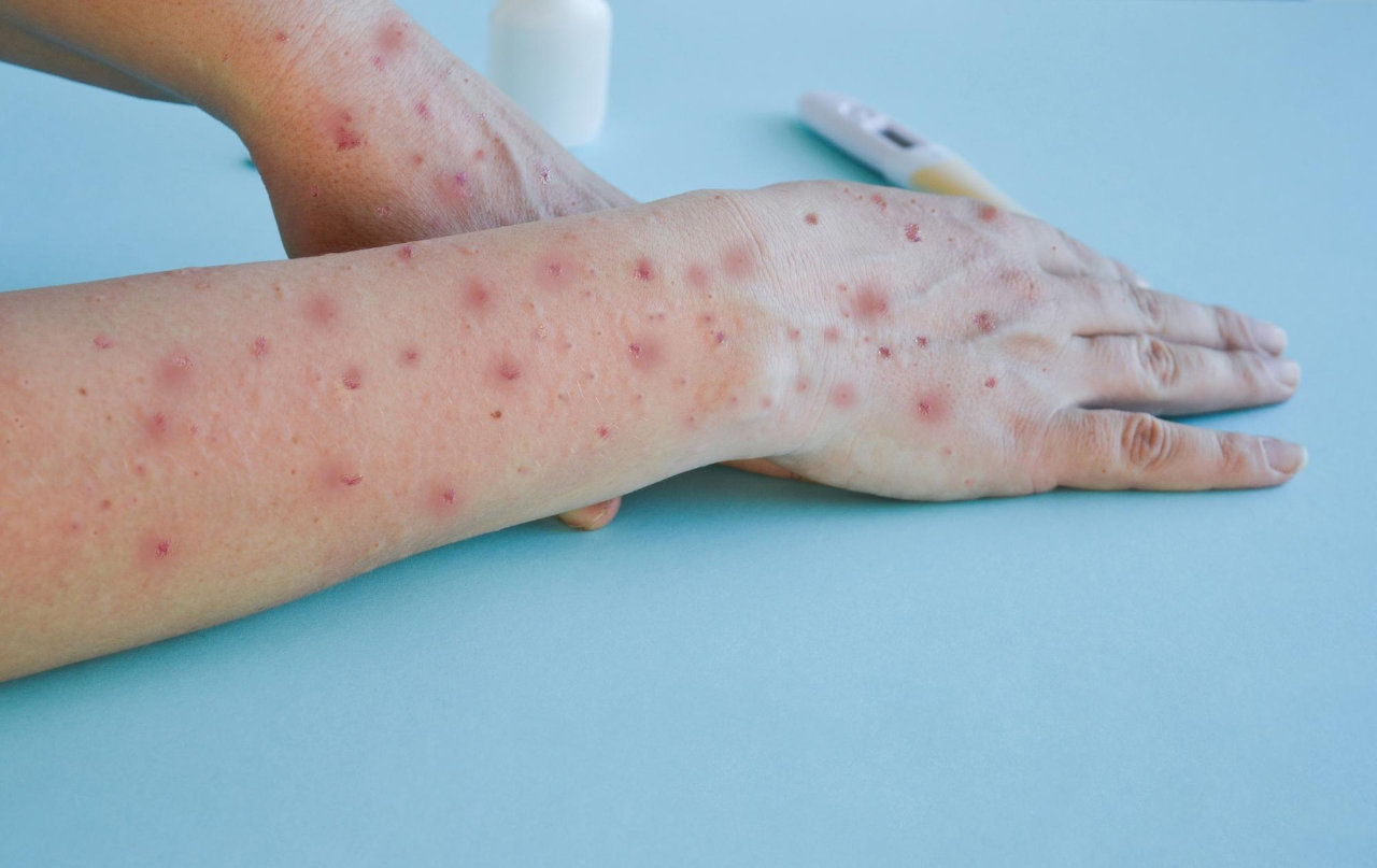 An image showing a forearm extending to a hand with visible small red spots and mild inflammation across the skin, resting on a pale blue surface. A small white bottle and a digital thermometer lie partially visible in the background, suggesting medical treatment or testing.